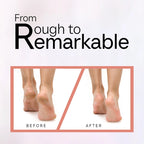 Salon like feets in 15 minutes with sofftouch Callus Remover