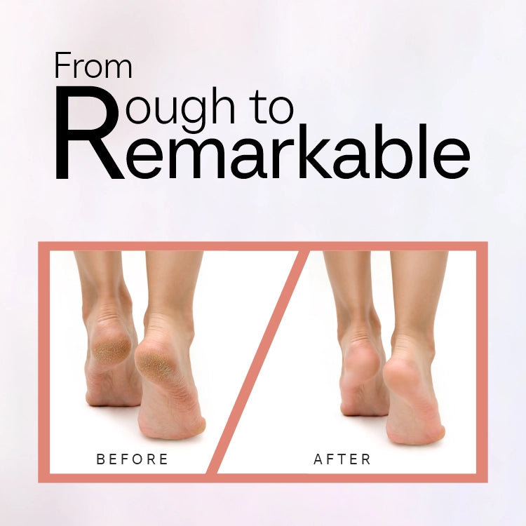 Salon like feets in 15 minutes with sofftouch Callus Remover
